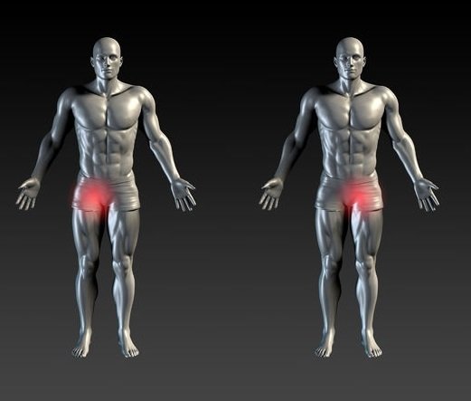Groin pain treatment